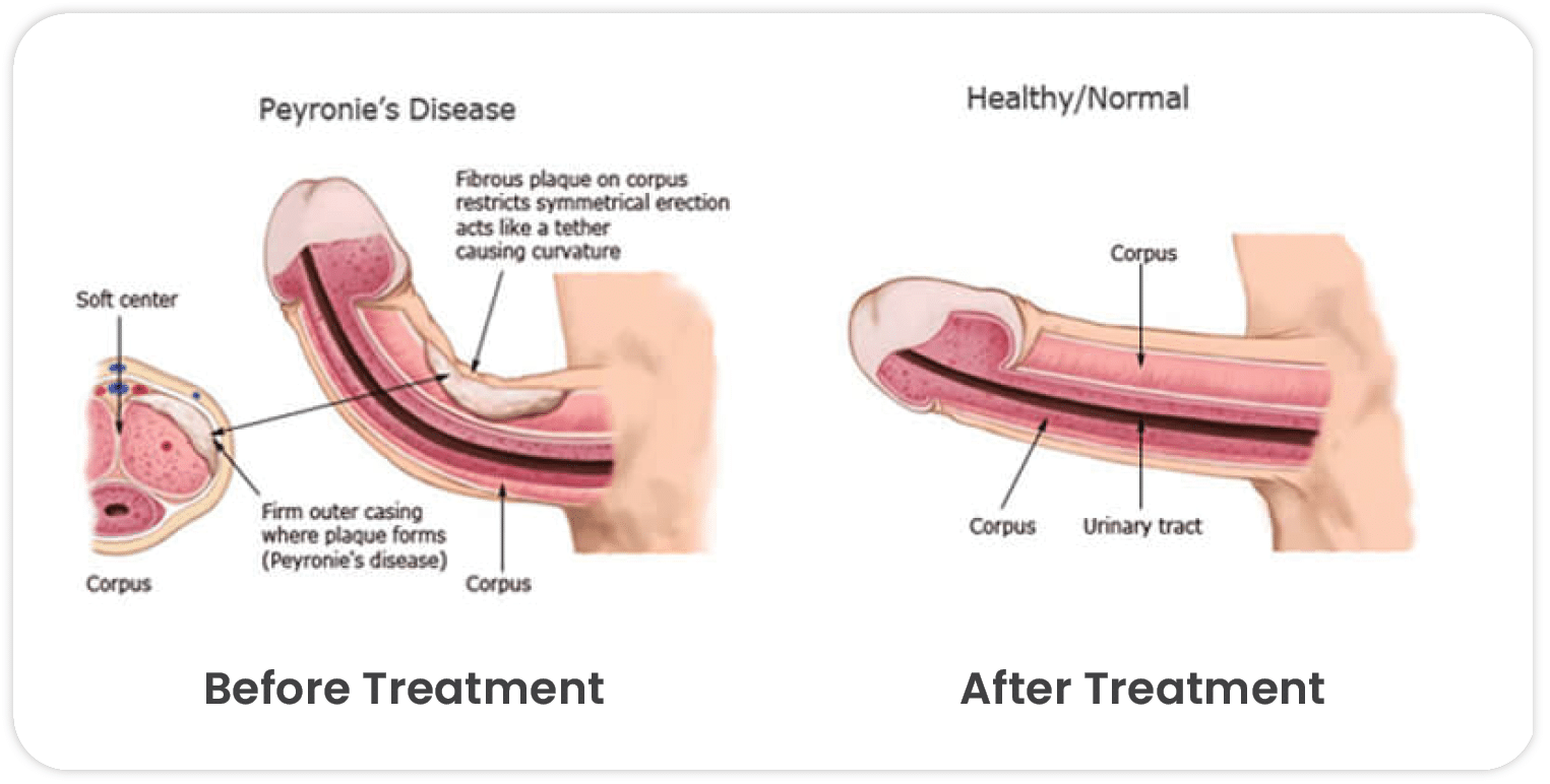 What is Peyronie's Disease