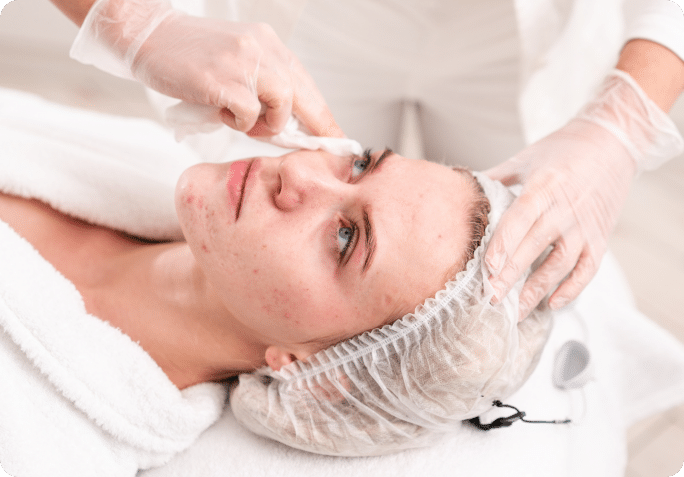 how do acne facial treatments work